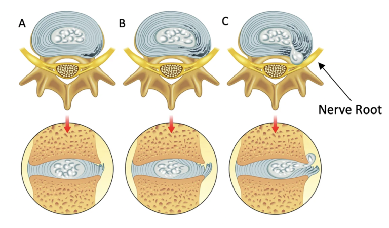 Bulging Disc L4-L5 – 2023 Guide to Symptoms & Treatment